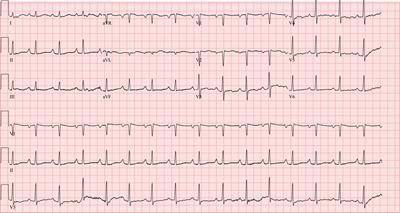 Case report: eosinophilic myocarditis in hypereosinophilic syndrome: a journey to heart transplantation